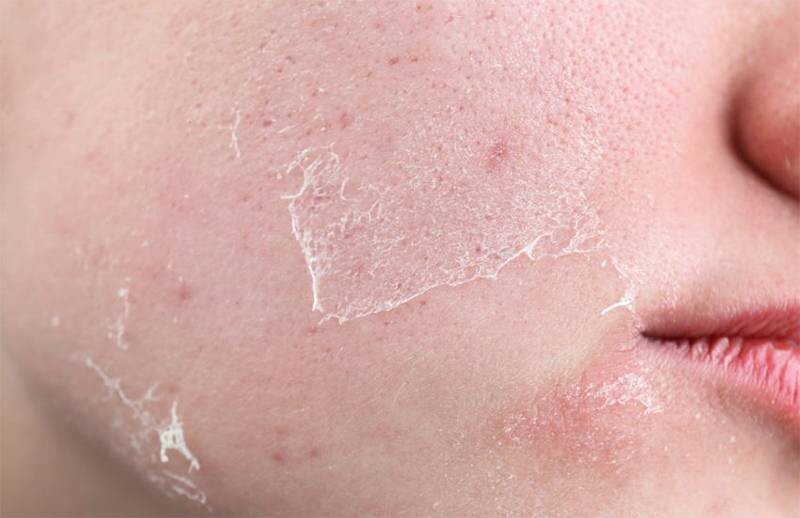 Quá trình bong tróc sau khi peel da diễn ra theo một chu kỳ tái tạo tự nhiên.