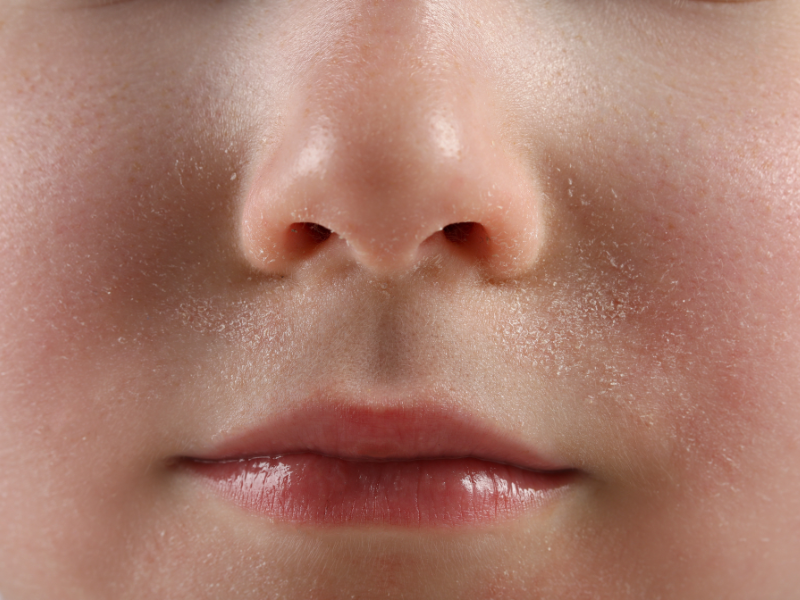 Phân biệt các cấp độ peel da nông, trung bình và sâu để xác định thời gian bong.